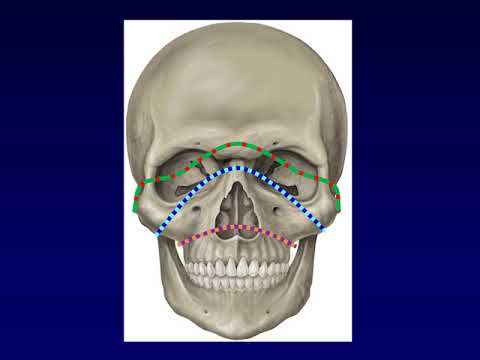 Facial Fractures 1