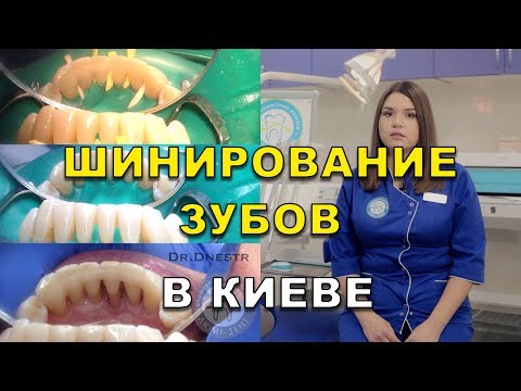 Шинирование зубов у стоматолога в Киеве (видео) - Люми-Дент