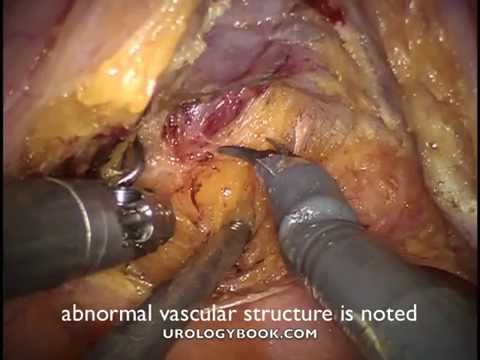 Seminal Vesicle Cyst Excision