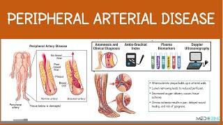 Peripheral Arterial Disease | Risk factors, Classification, Diagnosis and Interventions Simplified