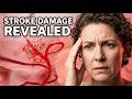 Hemorrhagic Brain Stroke See The Damage Unfold HD Animation
