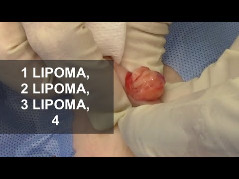 Lipoma vagy parazita - Mit jeleznek a bőr alatti zsírcsomók Féregtojások a bőr alatt