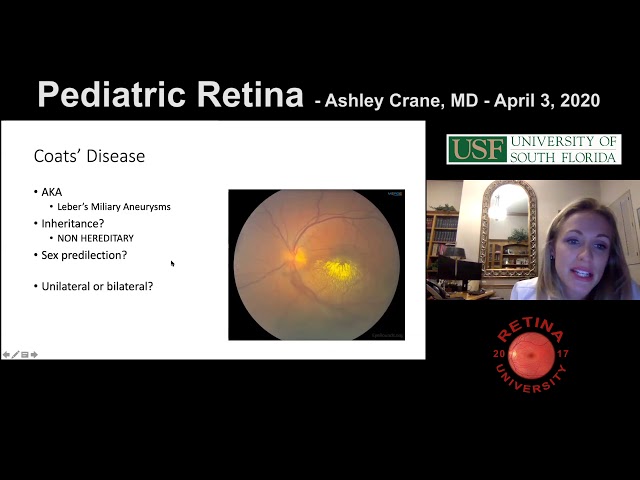 Vídeo relacionado con Handbook of Pediatric Retinal Disease (Springer Handbook of) (English Edition)
