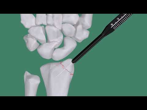 Double Medical Headless Compression Screw I (Version 2)