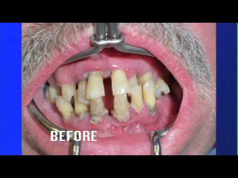 No Dentures Dental Implants
