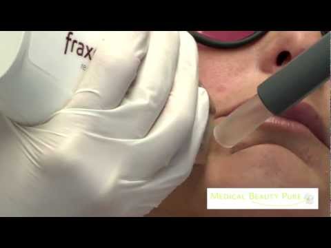 download lagu mp3 mp4 Fraxel Laser Kln, download lagu Fraxel Laser Kln gratis, unduh video klip Fraxel Laser Kln