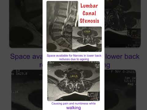 Spondylosis minimally invasive treatment - Dr. Mohit Muttha