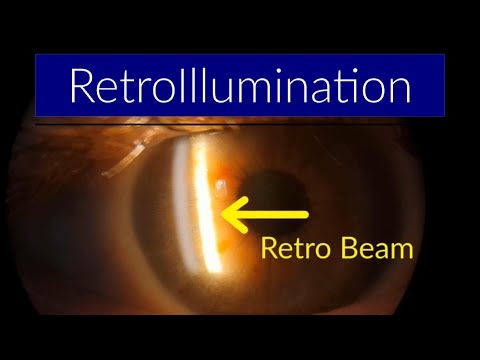 RetroIllumination - Slit Lamp Techniques