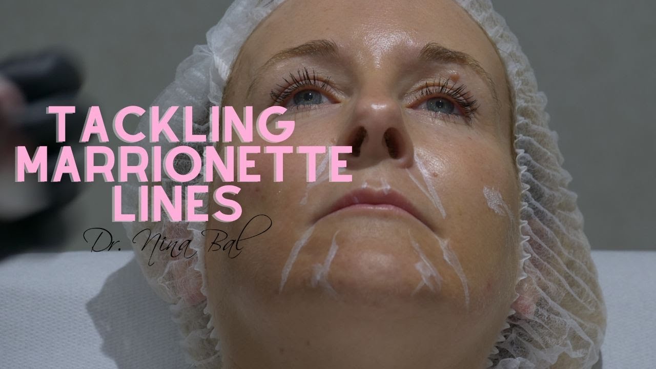 Lines Facial Sculpting