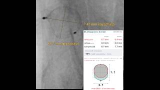 Artisse sizing for brain aneurysm using the dynamic height explorer