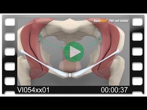 DynaMesh®-PRP - Animation: Pectopexy with Anterior & Posterior Mesh Repair