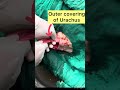Urachus L Symptoms Of Urachus L Urachus In Calf L Treatment Of Urachus L Dr Umar Khan