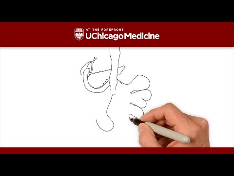 What is the Duodenal Switch Procedure