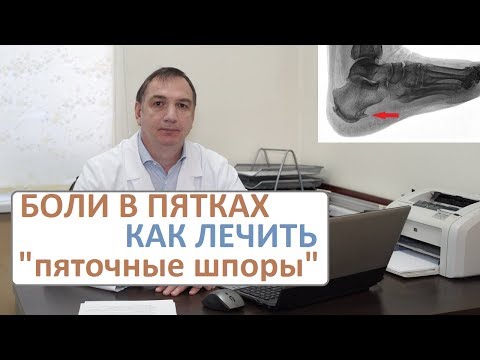 Боли в пятках, лечение. Пяточные шпоры - как их лечить.