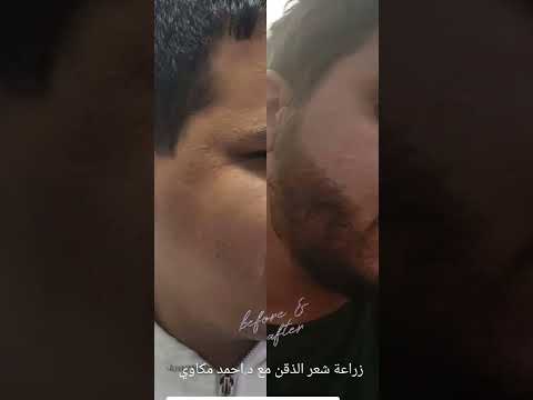 زراعة شعر الذقن ونتيجة مبهرة مع د.أحمد مكاوي