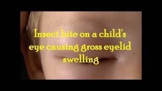 Gross eye swelling on a child following an insect bite and treatment