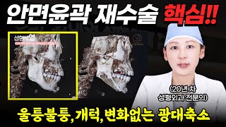 [윤곽재수술] 안면윤곽 ‘효과 없음’? 울퉁불퉁·개턱·광대 실패한 이유와 재수술의 해답(3D-CT설명포함)