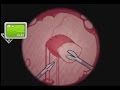OPERATE NOW PERICARDIUM SURGERY SURGERY GAMES