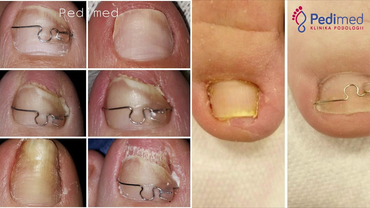 Wrastające paznokcie – przyczyny, objawy i sposoby leczenia w Klinice Podologii w Pedimed w Krakowie