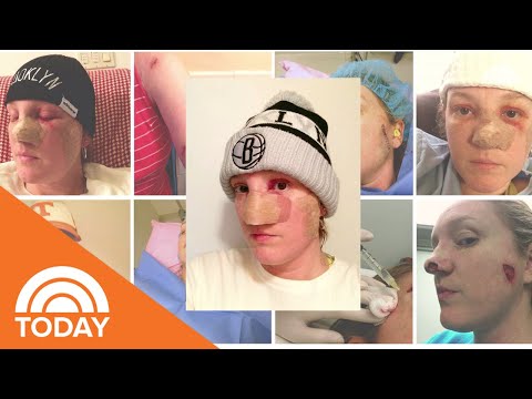 Melanoma Survivor Shares Her Story After Countless Skin Cancer Surgeries | TODAY