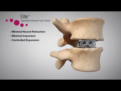 Elite™ Expandable Interbody Fusion System Animation