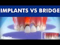 Dental Implants VS Tooth Bridge Comparison