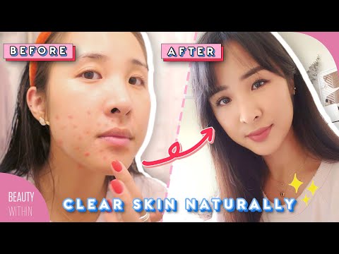 💢Top 3 Foods to AVOID for Clear Skin 💢 Treat Acne & Breakouts Naturally! 🌱 Video