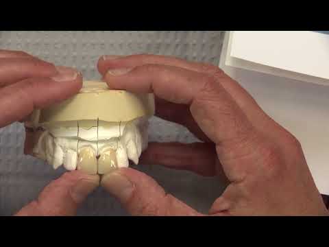 Case of the Week #90: Full-Arch All-on-X Restorations