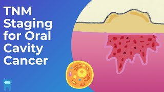 Download lagu How do we stage oral cancer? | TNM Classification and Staging for Oral Cavity Cancers mp3 Download lagu How do we stage oral cancer? | TNM Classification and Staging for Oral Cavity Cancers mp3