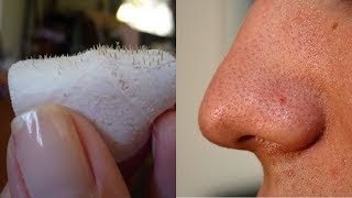 Easiest Trick To Remove Blackheads And Get Glowing Face