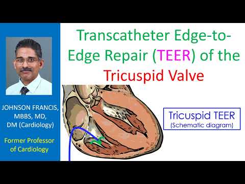 Transcatheter edge to edge repair (TEER) of the tricuspid valve