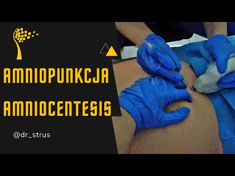 Amniopunkcja – przebieg badania // Amniocentesis - medical procedure