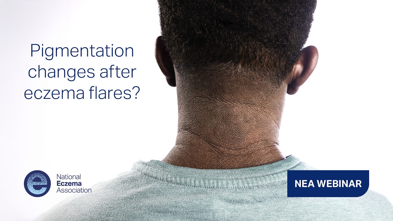 Understanding Pigmentation Changes in Eczema: Hypopigmentation and Hyperpigmentation