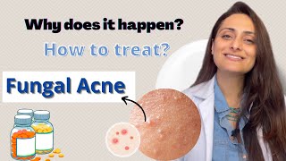 Fungal Acne | Why does it happen | How to treat | Dermatologist | Dr. Aanchal Panth