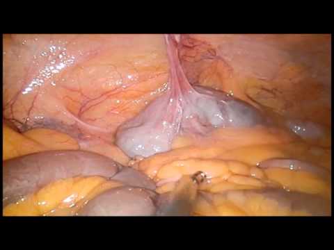 Dezintoxicare a ficatului de rinichi de colon