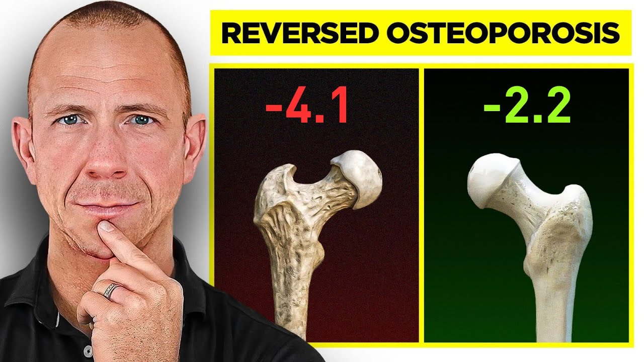 How This 55-Year-Old Woman Naturally Reversed Osteoporosis | Doctor Explains Complete Routine