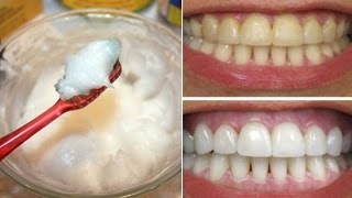 How To Whiten Your Yellow Teeth Naturally At Home (दांत चमकाना)/Tooth Whitening
