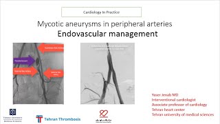 mycotic aneurysms in peripheral arteries endovascular management