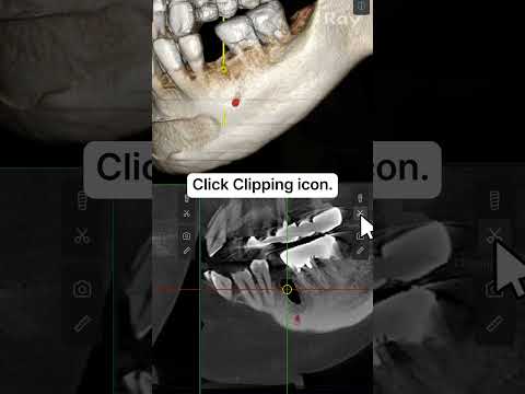 SMARTDent : 5D Tutorial #3-5. Immediate Implant Placement