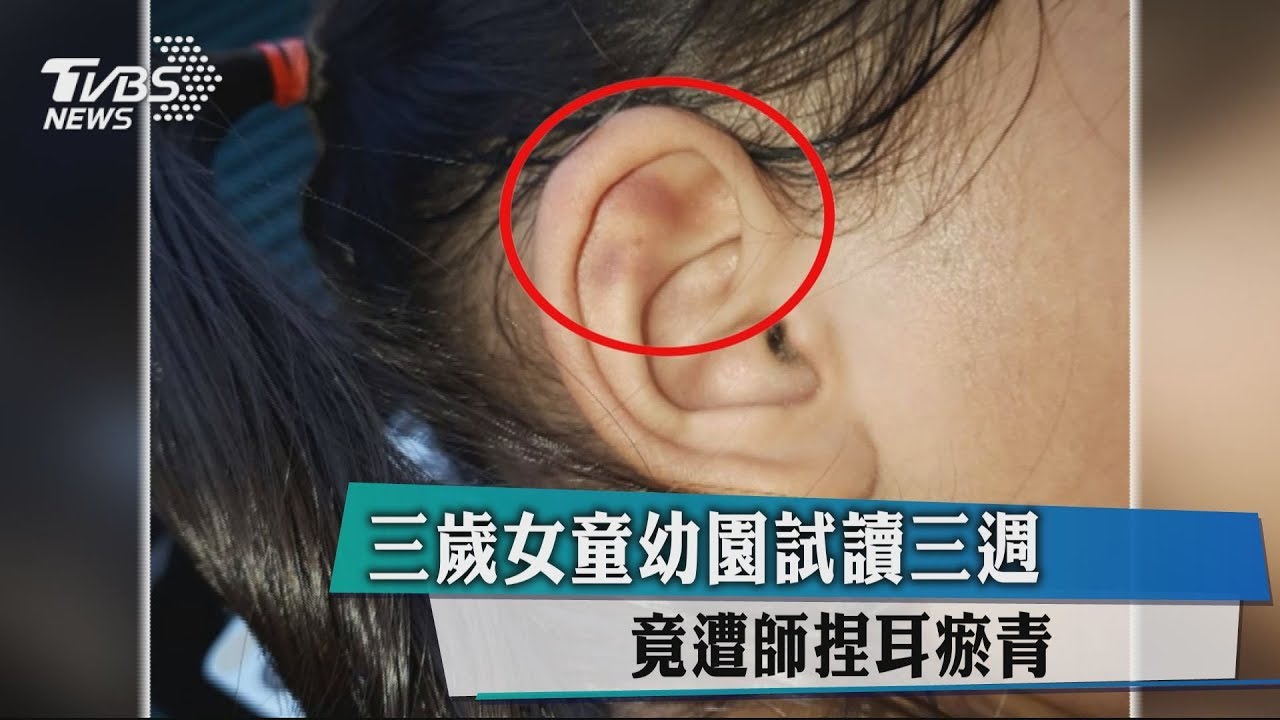 3歲女童幼園試讀3週 竟遭師捏耳瘀青