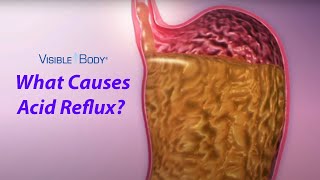 Visible Body | What Causes Acid Reflux?