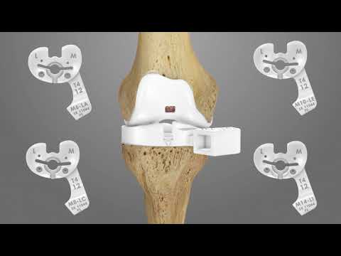iTotal PS Knee Replacement Surgical Technique Animation | Conformis