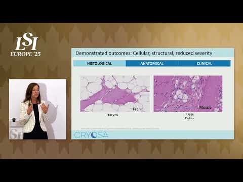 Laura Stoltenberg, Cryosa - Advanced Sleep Apnea Therapy | LSI Europe '25