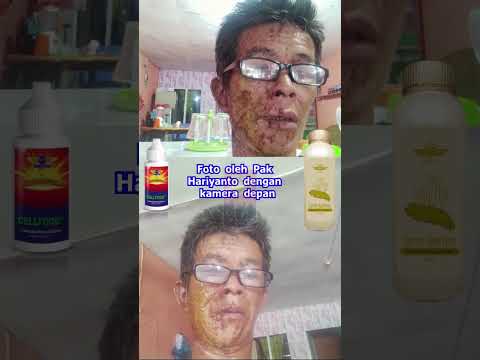 Pengalaman Merawat Kulit Terbakar Akibat Tersiram Air Keras