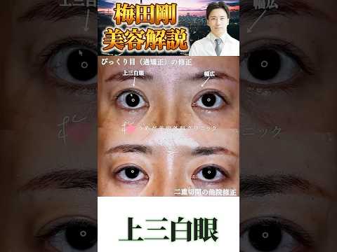 医学科 開き過ぎた目を戻す修正 #うめだ美容外科クリニック #美容外科 #眼瞼下垂