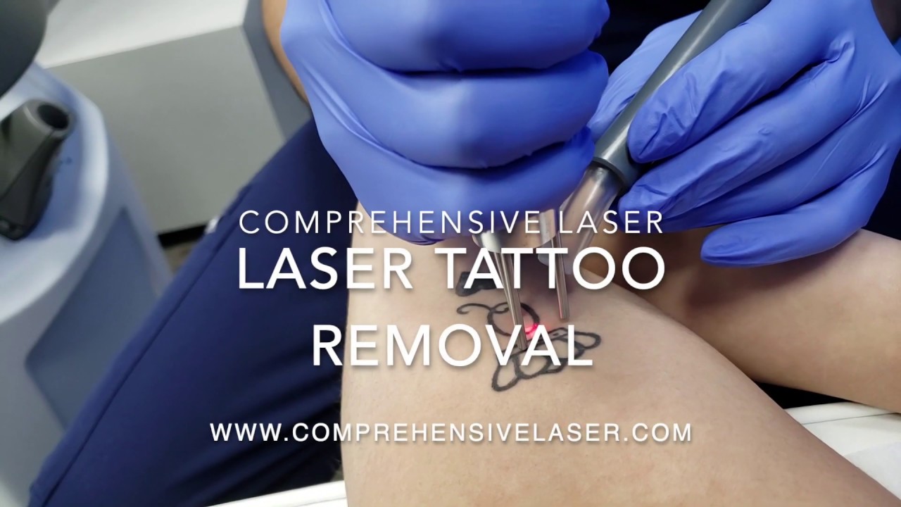 Laser Tattoo Removal Baltimore