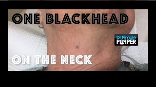 One blackhead on the neck extracted