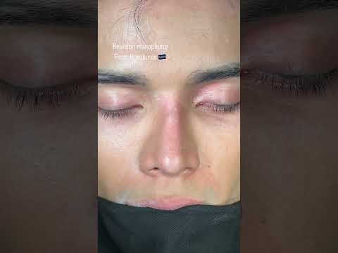 2nd Revison Rhinoplasty || Before and After #revisionrhinoplasty