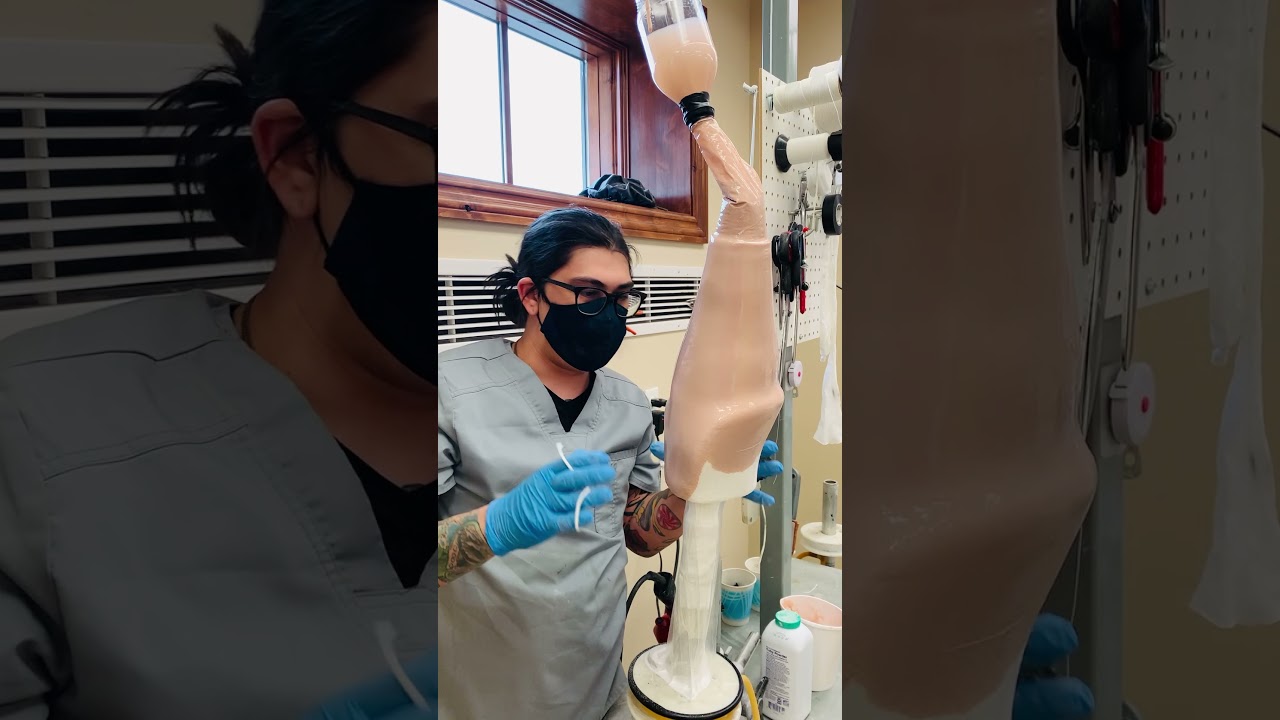 Fabricating a Custom Prosthetic Socket