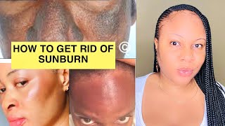 HOW TO CURE OR HEAL SUNBURN NATURALLY | AT HOME | FAST & EASY RESULTS